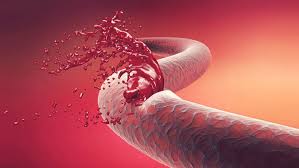 مبتلایان به هموفیلی هم خون میخواهند هم مهربانی!///لطفا منتشر نشود درحال تکمیل مبتلایان به هموفیلی هم خون میخواهند هم مهربانی!///لطفا منتشر نشود درحال تکمیل