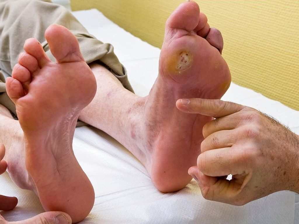 عارضه پای دیابتی