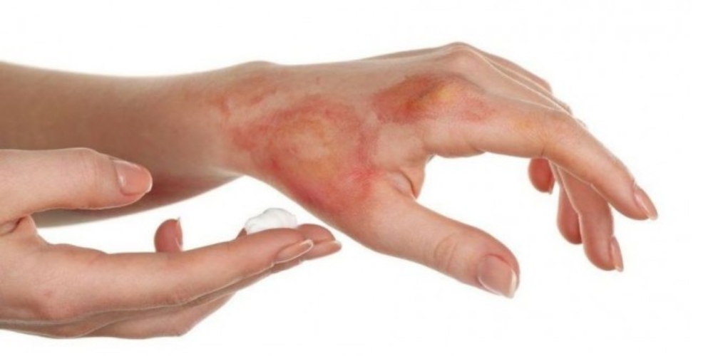 آشنایی با انواع سوختگی و درمان آن آشنایی با انواع سوختگی و درمان آن