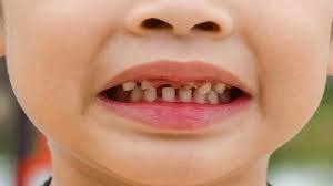 ارائه خدمات ویژه نقایص مینایی دندان به کودکان اردبیلی
