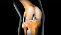 عمل تعویض مفصل زانو رایگان انجام می شود